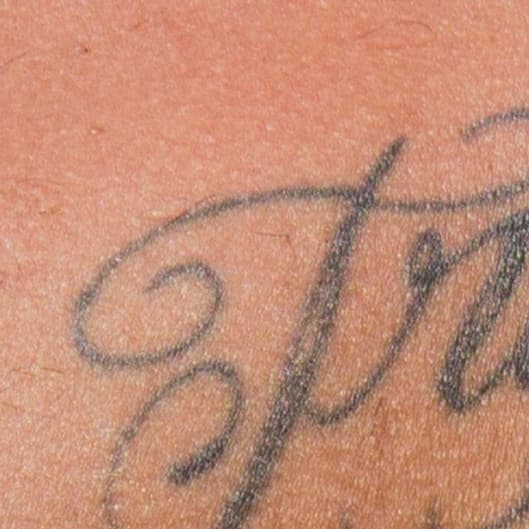 Alma Tattoo Removal Medium Area-6 at Dreamland Health and Wellness in Indianapolis, IN